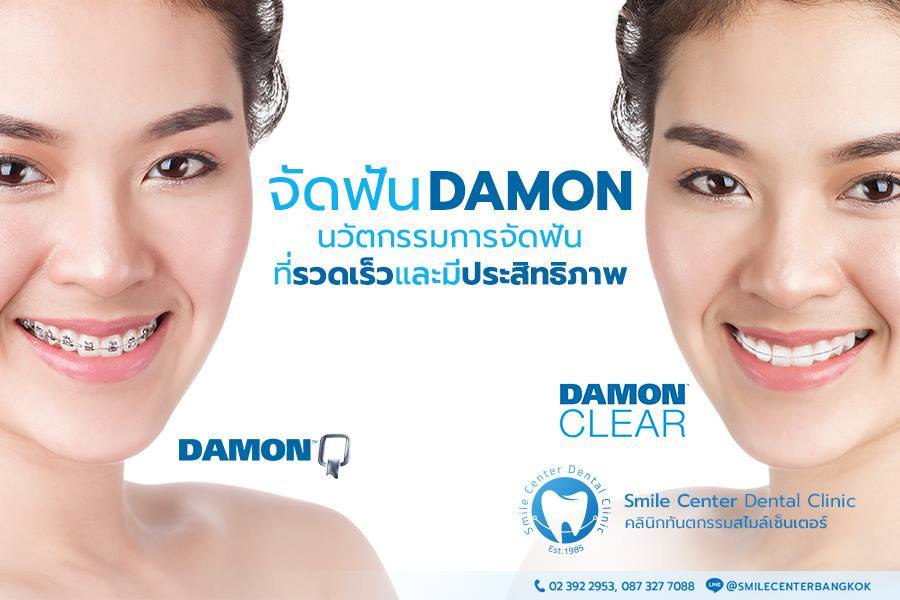 Damon Braces - Smile Center Dental Clinic